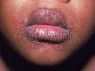 Clinical image of Perioral dermatitis of childhood