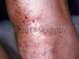 Clinical image of Dermatitis herpetiformis - imageId=117824. Click to open in gallery.  caption: 'A close-up of excoriated papules / vesicles near the knee.'