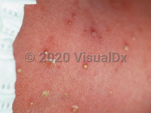 Clinical image of Transient neonatal pustular melanosis - imageId=119239. Click to open in gallery.  caption: 'A close-up of numerous small pustules.'