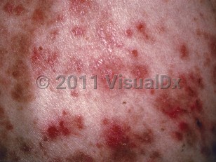 Clinical image of Pemphigus foliaceus - imageId=119629. Click to open in gallery.  caption: 'A close-up of superficial erosions and crusts and some postinflammatory hyperpigmentation.'