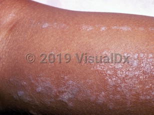 Clinical image of Lichen striatus - imageId=1234855. Click to open in gallery.  caption: 'Multiple violaceous scaly papules and plaques in a blaschkoid distribution on the calf.'