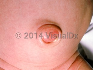 Clinical image of Omphalitis of the newborn - imageId=1245184. Click to open in gallery.  caption: 'Erythema, edema, and purulence of the umbilicus.'