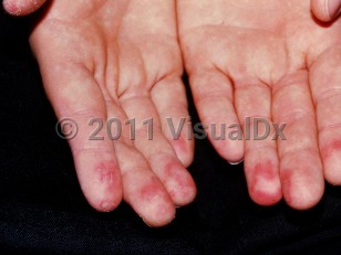 Clinical image of Symmetrical lividity of the palms or soles