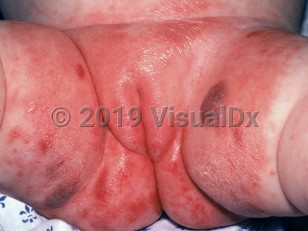 Clinical image of Granuloma gluteale infantum - imageId=1248959. Click to open in gallery.  caption: 'A large, shiny, wrinkled erythematous plaque, covering the area that has been in contact with the diaper (irritant diaper dermatitis), and scattered maroon-colored nodules on the inner thighs (granuloma gluteale infantum).'