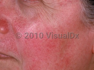 Clinical image of Tumid lupus erythematosus - imageId=1256764. Click to open in gallery.  caption: 'A smooth, erythematous plaque on the upper cutaneous lip (tumid LE) and surrounding erythema on the cheek (malar rash of SLE).'