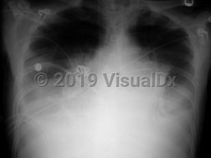 Imaging Studies image of Inhalational anthrax - imageId=1264042. Click to open in gallery. 