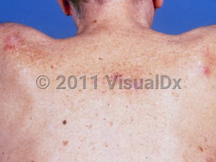Clinical image of Chronic lymphocytic leukemia - imageId=1267391. Click to open in gallery.  caption: 'Pink and whitish papules and plaques on the upper back.'