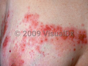 Clinical image of Herpes zoster