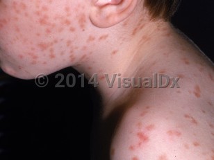 Clinical image of Urticaria pigmentosa - imageId=1316038. Click to open in gallery.  caption: 'Myriad red-brown macules and papules on the face, neck, and back.'