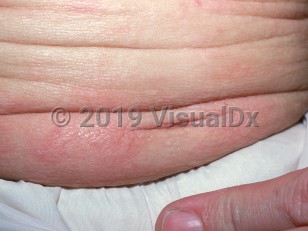 Clinical image of Diffuse cutaneous mastocytosis