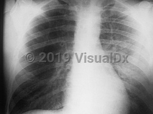Imaging Studies image of Pneumonic plague