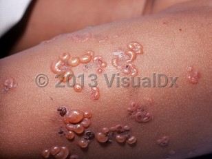 Clinical image of Linear IgA bullous dermatosis of childhood - imageId=1332727. Click to open in gallery.  caption: 'Tense vesicles, some umbilicated and some in arcuate arrays, and secondary crusting on the arm. '