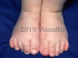 Clinical image of Nager syndrome - imageId=1337665. Click to open in gallery.  caption: 'Partial syndactyly and clinodactyly of the toes.'