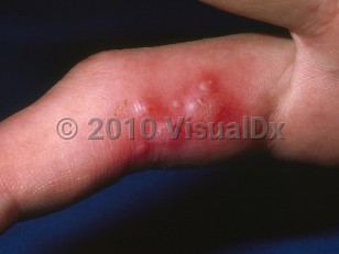 Clinical image of Herpetic whitlow