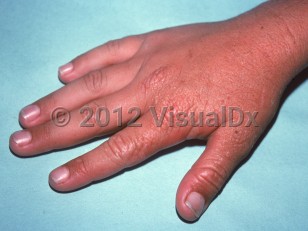 Clinical image of Protoporphyria - imageId=1342463. Click to open in gallery.  caption: 'Thickened, rugose, vesiculated skin over the dorsal hand and fingers.'