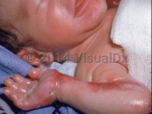 Clinical image of Generalized severe epidermolysis bullosa simplex