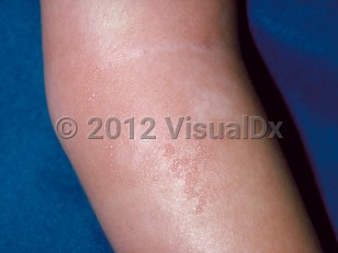 Clinical image of Eosinophilic cellulitis - imageId=138734. Click to open in gallery.  caption: 'A large, vesiculated, edematous pink plaque on the arm.'