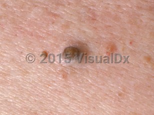 Clinical image of Dilated pore of Winer - imageId=1388543. Click to open in gallery.  caption: 'A close-up of a keratin-filled pore.'