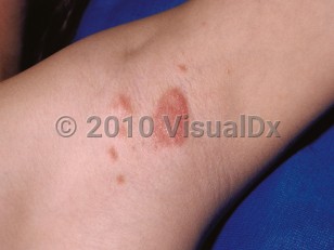 Clinical image of Inverse psoriasis