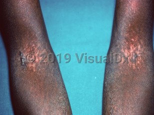 Clinical image of Hereditary sclerosing poikiloderma - imageId=1414620. Click to open in gallery.  caption: 'Poikilodermatous plaques with overlying linear keratotic bands at the antecubital fossae.'