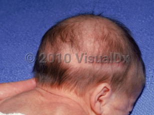 Clinical image of Halo scalp ring - imageId=1417919. Click to open in gallery.  caption: 'An arcuate broad band of alopecia on the posterior and lateral scalp.'