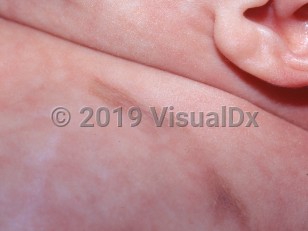 Clinical image of Anetoderma of prematurity