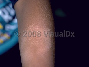 Clinical image of Pityriasis alba