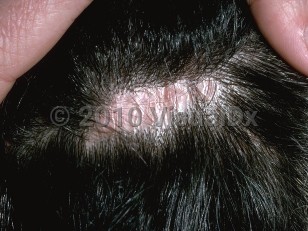 Clinical image of Lichen planopilaris - imageId=143971. Click to open in gallery.  caption: 'A close-up of late stage lichen planopilaris showing a wrinkled pink-white plaque of scarring alopecia on the scalp.'