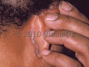 Clinical image of Seborrheic dermatitis