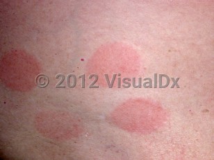 Clinical image of Allergic contact dermatitis - imageId=1446. Click to open in gallery.  caption: 'A close-up of round and oval, pink plaques with scant scale.'