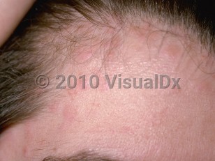 Clinical image of Hereditary angioedema - imageId=146652. Click to open in gallery.  caption: 'Numerous urticarial papules on the forehead.'