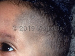 Clinical image of Nevus of Ota - imageId=1469618. Click to open in gallery.  caption: 'A large dark gray patch on the forehead and temple, extending into the scalp.'