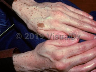 Clinical image of Multiple lentigines syndrome - imageId=1470876. Click to open in gallery.  caption: 'Myriads of brown macules on the hands.'