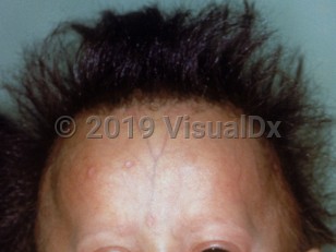 Clinical image of Progeria - imageId=1473531. Click to open in gallery.  caption: 'A large cranium, frontal bossing, loss of subcutaneous fat, and sparse eyebrows.'