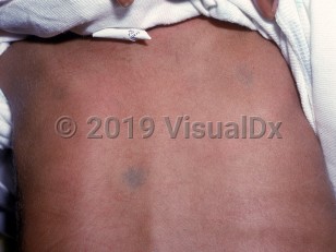 Clinical image of GM1 gangliosidosis - imageId=1477788. Click to open in gallery.  caption: 'Blue-gray macules on the back.'