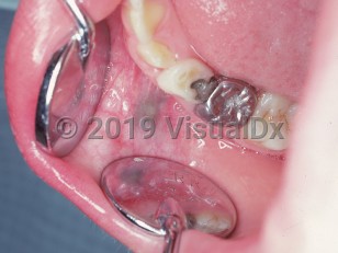 Clinical image of Amalgam tattoo - imageId=1482317. Click to open in gallery.  caption: 'Grayish macules in the vicinity of a filling on the buccal mucosa.'