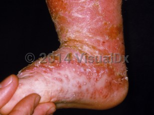 Clinical image of Infantile psoriasis