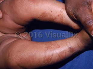 Clinical image of Kindler syndrome