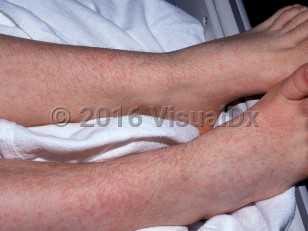 Clinical image of Adenovirus infection - imageId=1504256. Click to open in gallery.  caption: 'Diffuse faint pink macules, papules, and plaques on the legs and feet.'