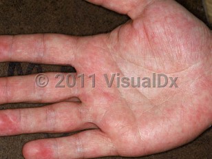 Clinical image of Papular-purpuric gloves and socks syndrome - imageId=1506677. Click to open in gallery.  caption: 'Patchy erythema of the palm and fingers.'