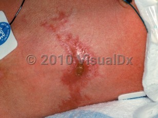 Clinical image of Congenital varicella syndrome - imageId=1507585. Click to open in gallery.  caption: 'Shiny erythematous papules and plaques in a dermatomal configuration, one with a central crusted ulcer, on the abdomen.'