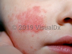 Clinical image of Enteroviral infection - imageId=1508508. Click to open in gallery.  caption: 'A vesiculated and crusted erythematous plaque and similar surrounding papules on the cheek.'