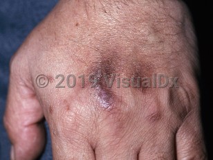 Clinical image of Drug-induced pigmentation - imageId=152129. Click to open in gallery.  caption: 'Brown and violaceous macules and patches on the dorsal hands, developing secondary to medication.'