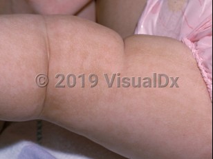 Clinical image of Linear and whorled nevoid hypermelanosis - imageId=1530346. Click to open in gallery.  caption: 'Linear and patterned brown patches in a blaschkoid distribution on the leg.'