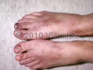 Clinical image of Granulomatosis with polyangiitis - imageId=153379. Click to open in gallery.  caption: 'Hemorrhagic bullae and vesicles on the distal toes and faint, maroon-colored patches on the dorsal feet.'