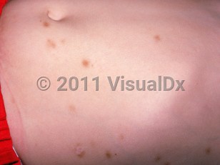 Clinical image of Toxocariasis