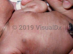 Clinical image of Fanconi anemia - imageId=1534971. Click to open in gallery.  caption: 'Diffuse hyperpigmentation and superficial scaling of the face and trunk.'