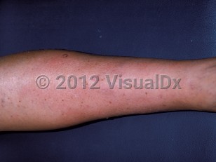 Clinical image of Calciphylaxis