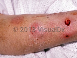 Clinical image of Skin bacterial abscess - imageId=154367. Click to open in gallery.  caption: 'Abscesses on the forearm, one with an ulcer and crust.'