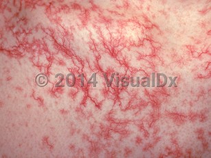 Clinical image of Generalized essential telangiectasia - imageId=1544705. Click to open in gallery.  caption: 'A close-up of telangiectatic patches.'